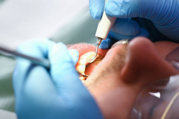 Best Emergency Root Canal Treatment in St Clairsville, OH