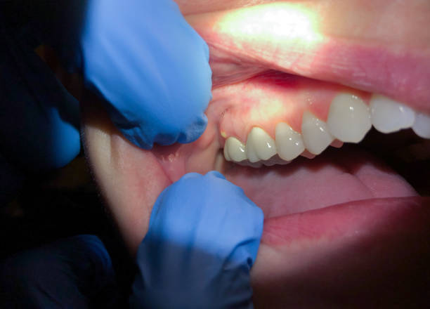 Best Urgent Care for Lost Fillings or Crowns in St Clairsville, OH