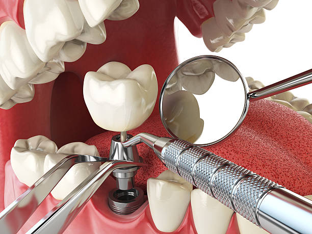 Best Emergency Treatment for Dental Infections or Abscesses in St Clairsville, OH